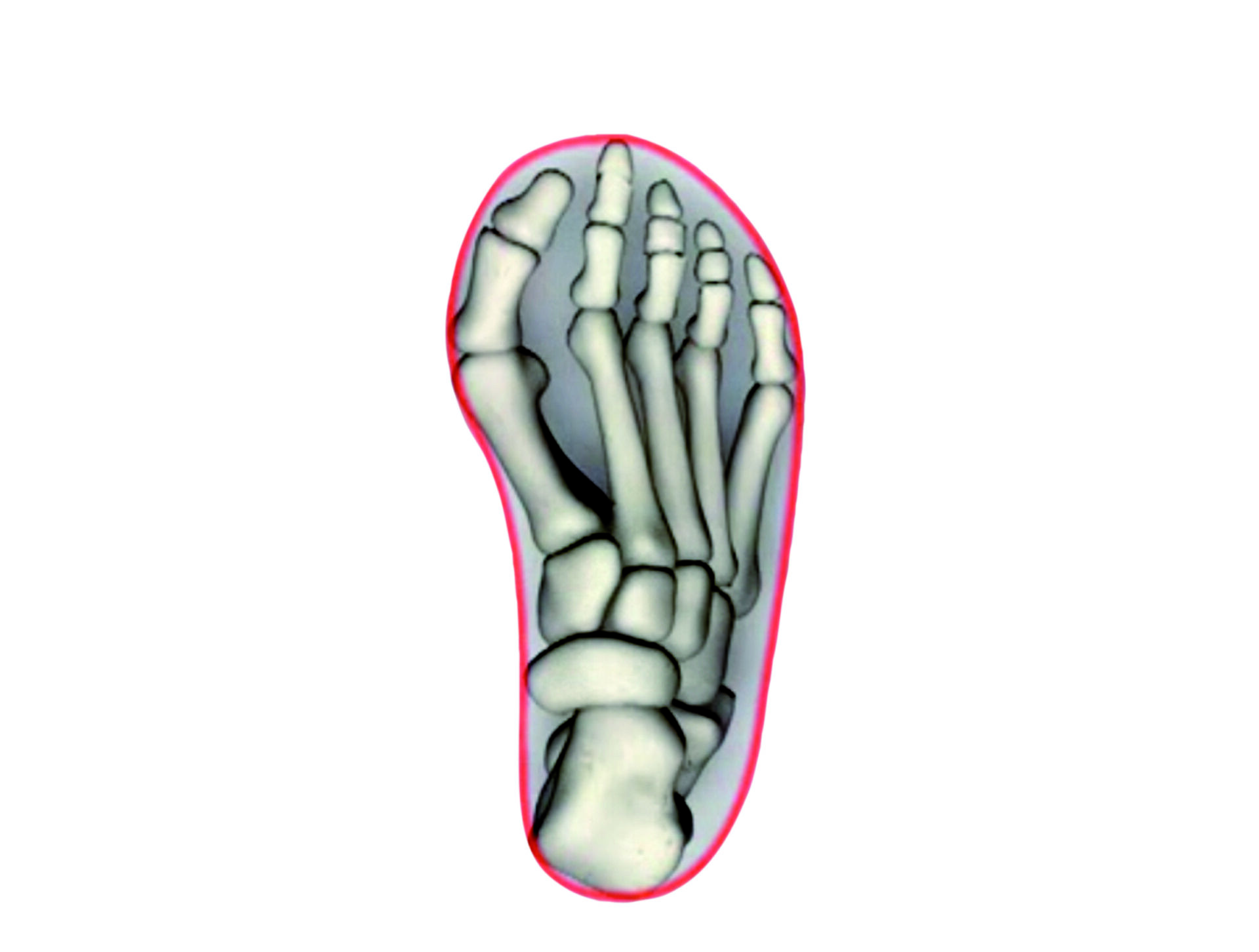 Handelsübliche, zu kurze Schuh-form=Fußdeformation!