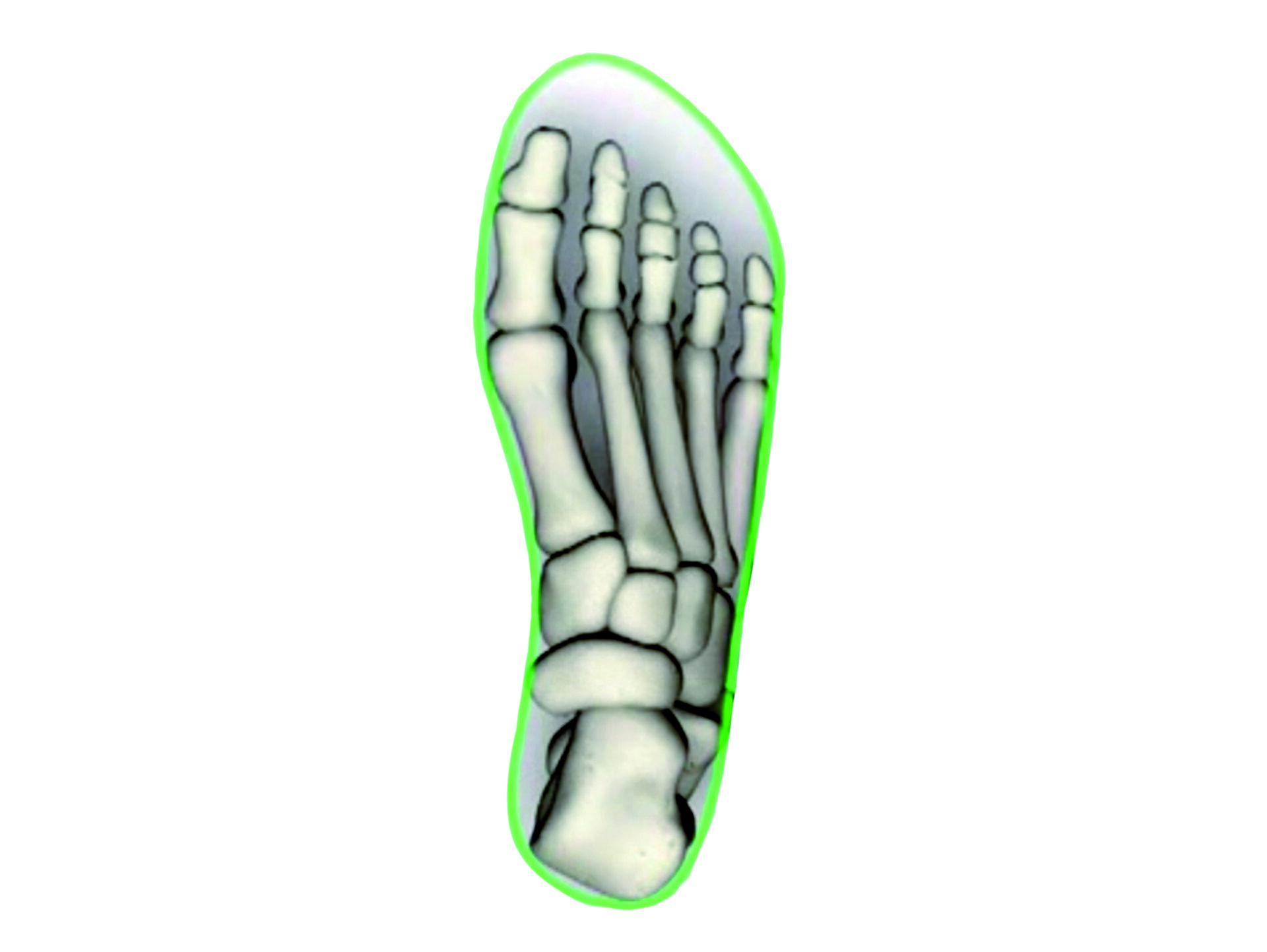 Anartomisch korrekte Schuh- und somit Fußform.